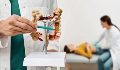 Câncer de intestino: doença cresce entre os jovens; saiba mais