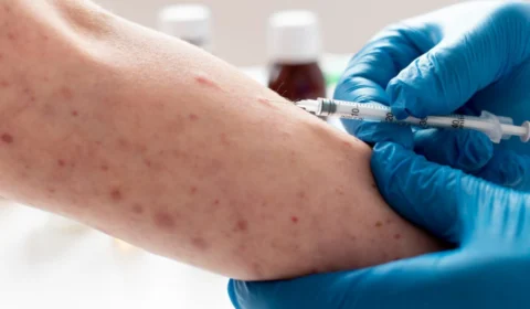 Mpox: Governo negocia a compra de 25 mil doses de vacina