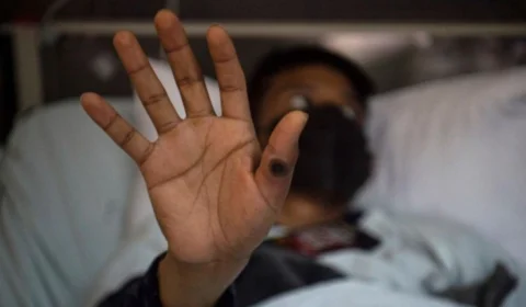 Mpox: Brasil está no primeiro nível de emergência; confira