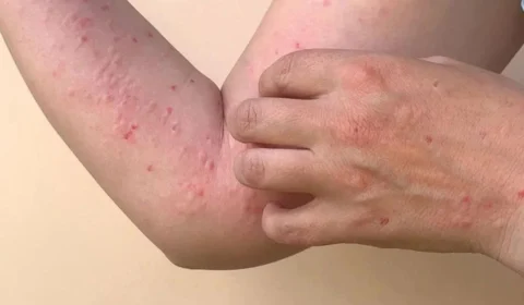 Mpox: Comitê de emergência será criado pelo Ministério da Saúde