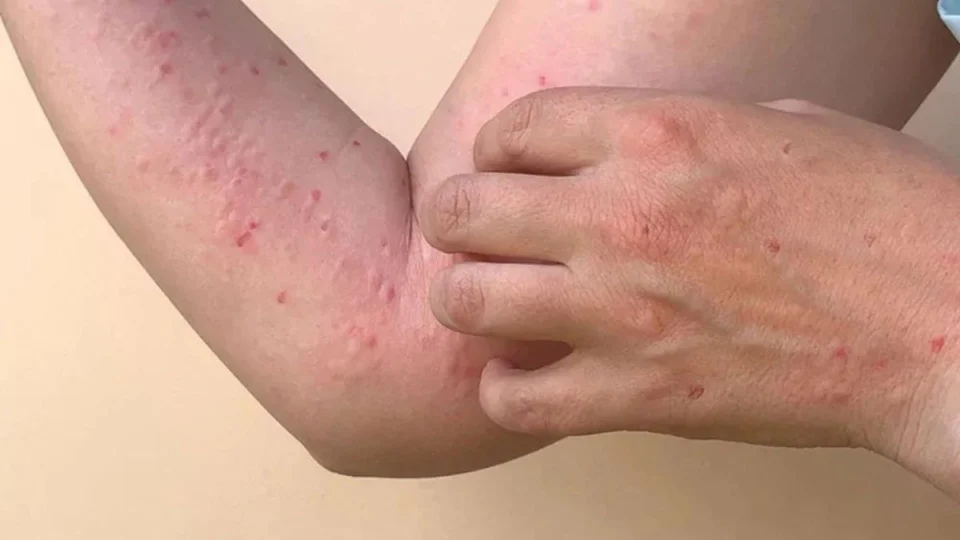 Mpox: número de casos globais da doença se aproxima de 100 mil