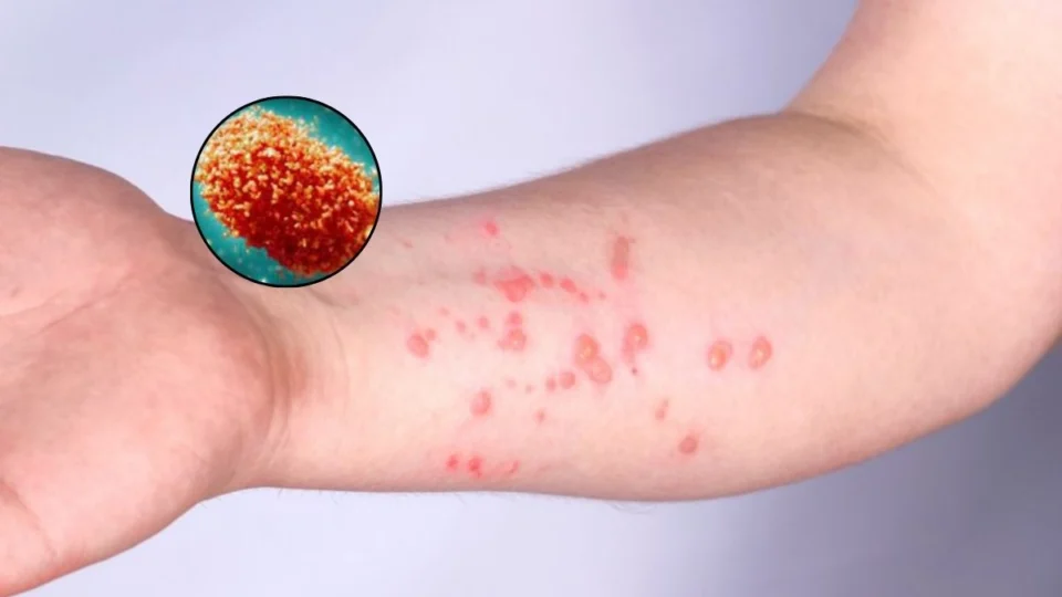 Mpox: novos casos da doença são registrados no Paquistão; veja