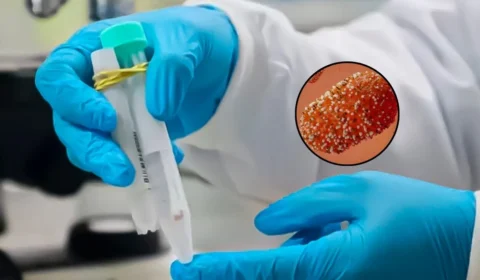 Mpox: novo boletim informa situação da doença no Amazonas; veja