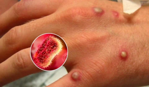 Mpox: confira os sintomas e as medidas para prevenir a infecção