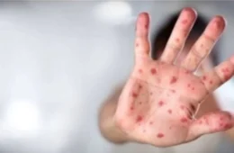 Brasil tem mais de 1,6 mil casos de ‘varíola dos macacos’ em 2024