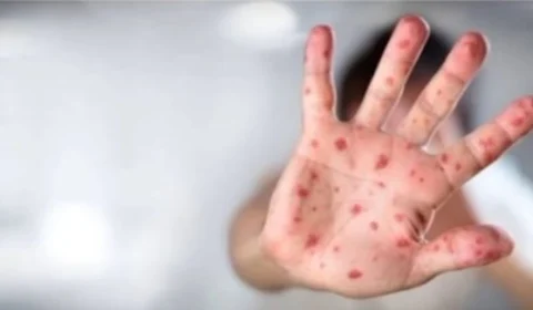 Brasil tem mais de 1,6 mil casos de ‘varíola dos macacos’ em 2024