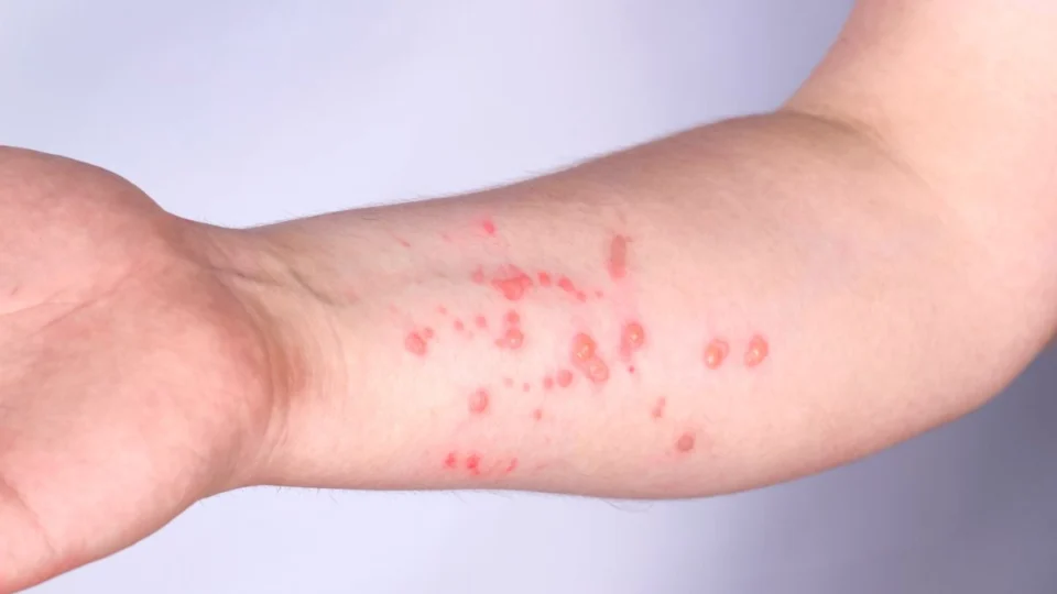 Mpox: Brasil bate recorde de 1000 casos confirmados