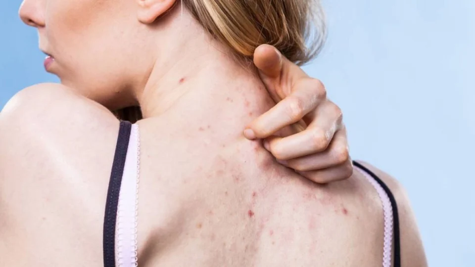 Acne no corpo: quais são as causas e como previnir?