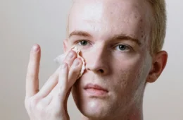 Manchas de acne: quatro dicas para remover as marcas de espinhas