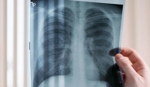 O que é bronquite? Entenda a doença que pode ser agravada pela fumaça das queimadas