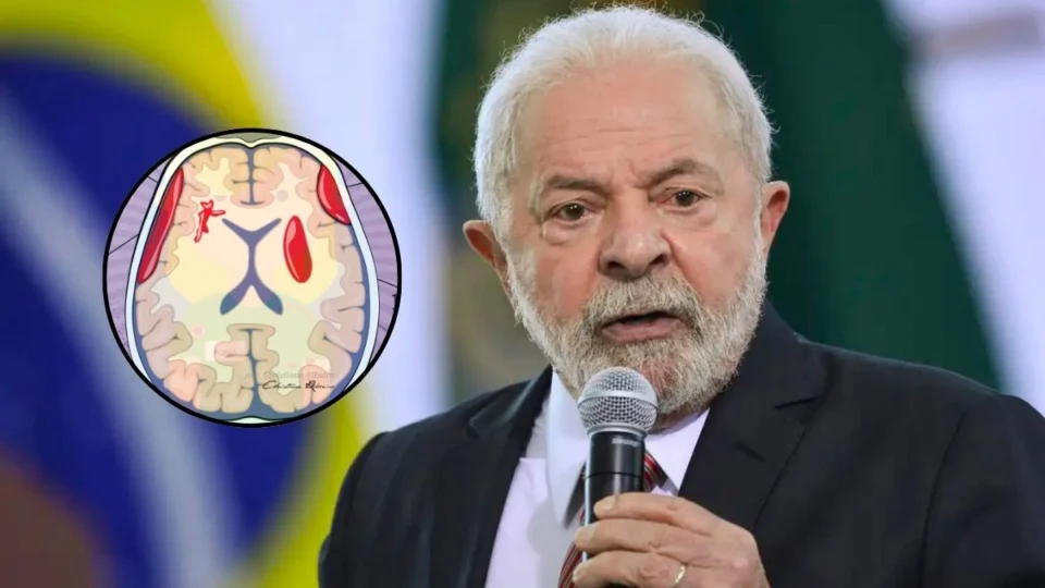 Hematoma cerebral: saiba o que é a condição que fez Lula cancelar viagem à Rússia