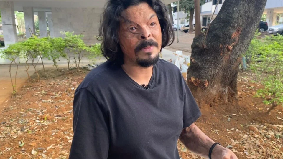 ‘Vi minha roupa evaporar, meu cabelo desaparecer’, relata sobrevivente de incêndio criminoso no DF