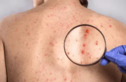 Dia Nacional de Combate à Sífilis: conheça a doença e seus estágios