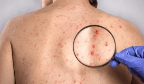 Dia Nacional de Combate à Sífilis: conheça a doença e seus estágios