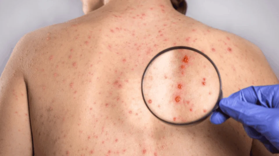 Dia Nacional de Combate à Sífilis: conheça a doença e seus estágios