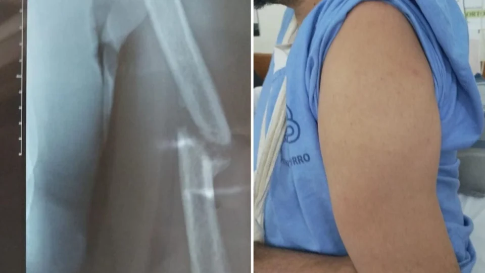 Paciente com braço quebrado há um ano aguarda por cirurgia no DF