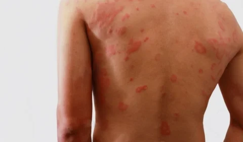 Hanseníase: Fiocruz lidera teste de vacina inédita no Brasil; entenda o que é a doença