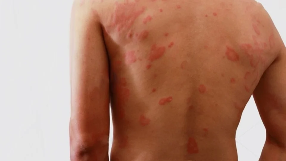 Hanseníase: Fiocruz lidera teste de vacina inédita no Brasil; entenda o que é a doença