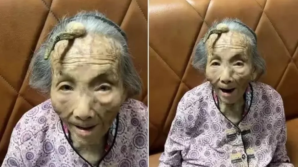 Idosa de 107 anos com chifre de 10 cm na testa viraliza na internet
