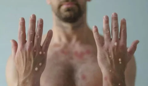 Mpox continua sendo emergência global em saúde pública, diz OMS