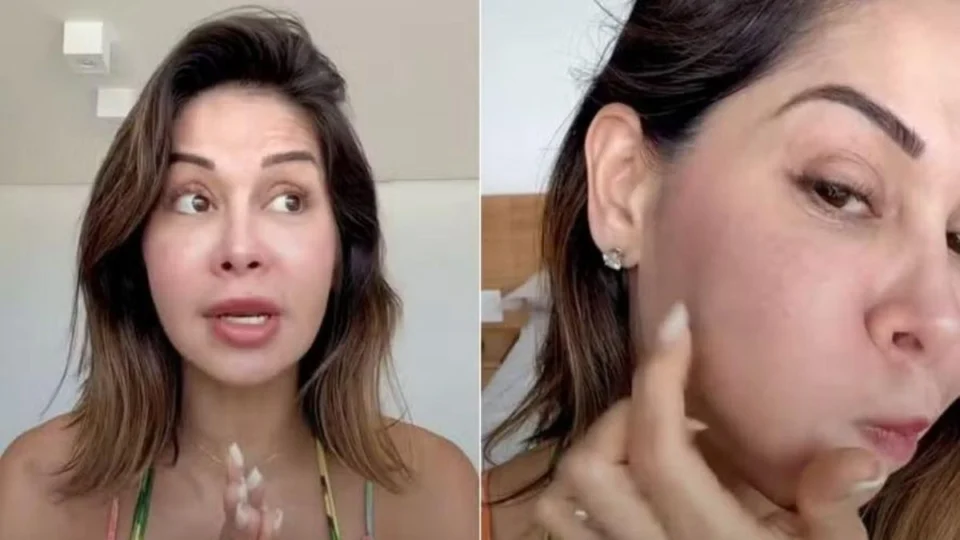 PMMA: saiba quais são os riscos da substância que causou inchaço no rosto de Maíra Cardi