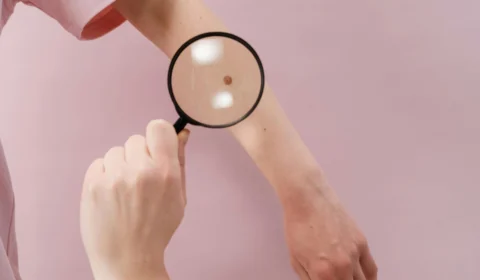 Não ignore estes sinais, pois pode ser câncer de pele: aprenda a identificar a doença silenciosa