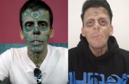 Homem ‘mais tatuado do Brasil’ enfrenta sessões de remoção de tatuagens em busca de recomeço