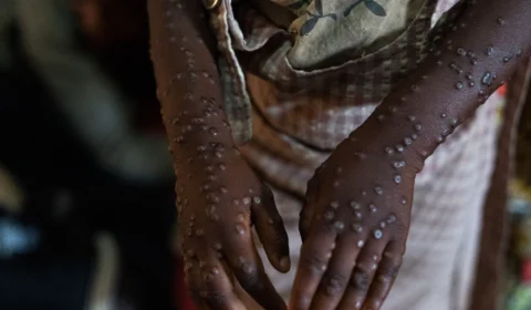 Casos de ‘varíola dos macacos’ aumentam no Amazonas, segundo dados da FVS-AM