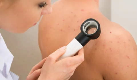 Dezembro Laranja destaca prevenção e detecção precoce do câncer de pele