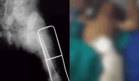 Criança de 1 ano é baleada por PM ‘Bolsonaro’ e é internada em Manaus