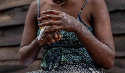 URGENTE: Saúde confirma primeiro caso de nova cepa de mpox no Brasil