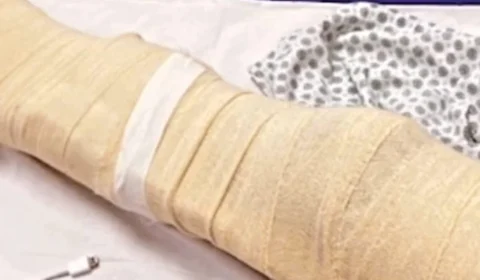 Mãe relata que filho teve corte profundo na perna causado por linha de papagaio em Manaus