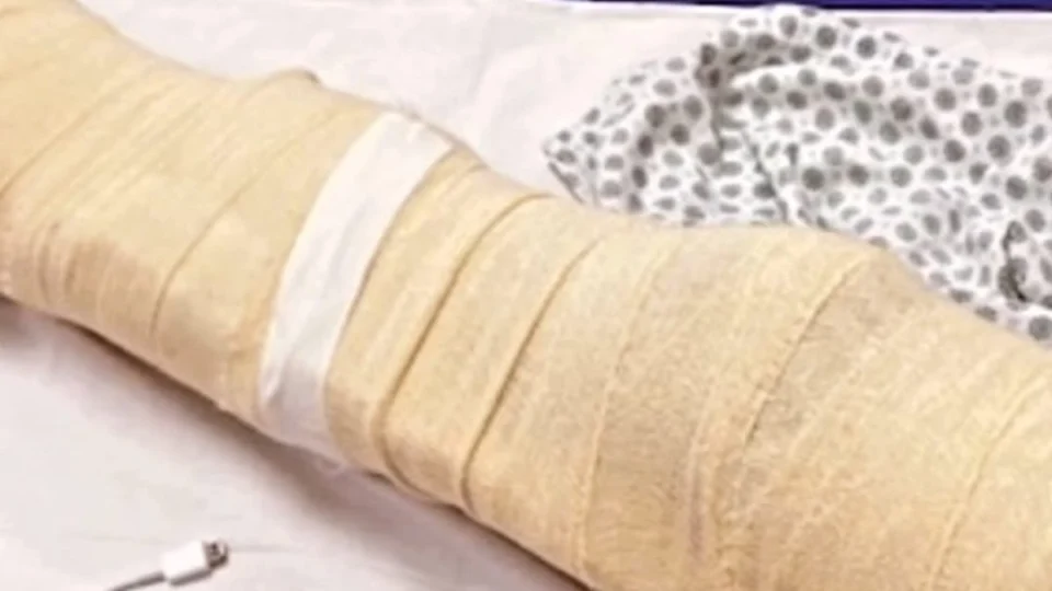 Mãe relata que filho teve corte profundo na perna causado por linha de papagaio em Manaus