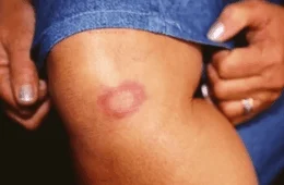 Corra para o médico se você estiver apresentando esses sintomas na pele; saiba tudo