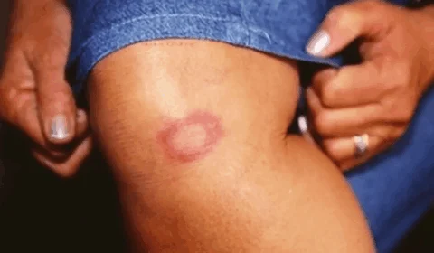 Corra para o médico se você estiver apresentando esses sintomas na pele; saiba tudo