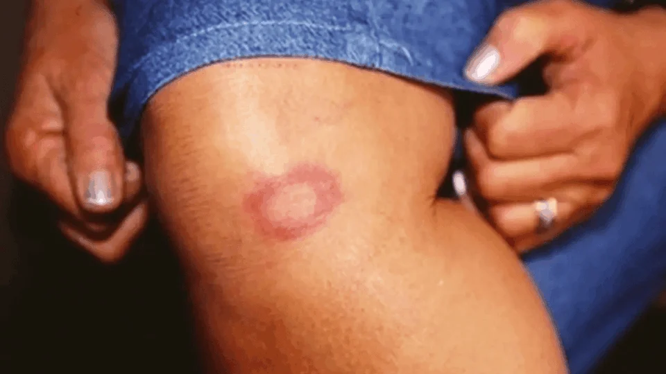 Corra para o médico se você estiver apresentando esses sintomas na pele; saiba tudo