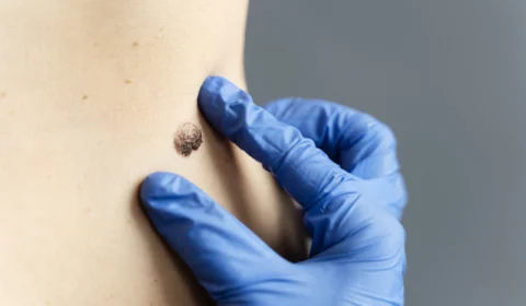 Proteja seus filhos contra verrugas infantis: tudo que você precisa saber sobre causas e tratamentos