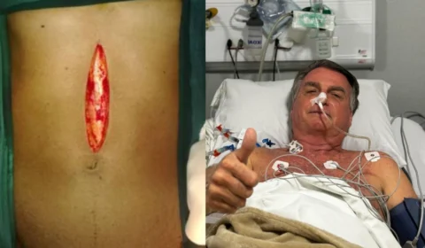 Entenda o que é laparotomia exploratória, cirurgia realizada por Jair Bolsonaro neste domingo (13)