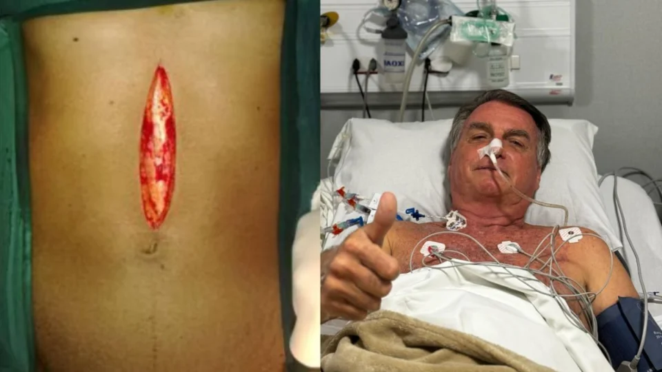 Entenda o que é laparotomia exploratória, cirurgia realizada por Jair Bolsonaro neste domingo (13)