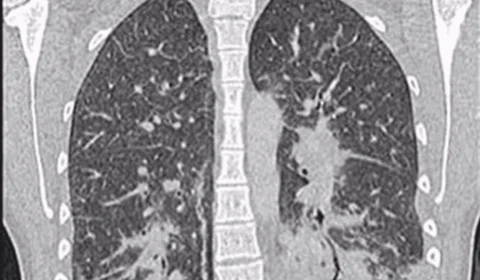 ‘Pulmão de pipoca’: conheça a doença bizarra que o vape causou nesta adolescente