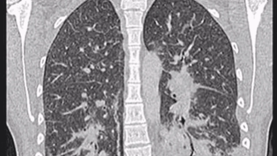 ‘Pulmão de pipoca’: conheça a doença bizarra que o vape causou nesta adolescente