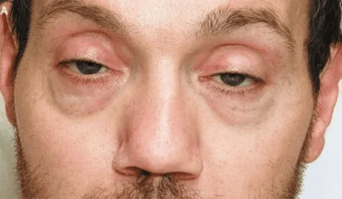 Botulismo: a doença grave que assusta pela facilidade de contágio; conheça os sintomas e previna-se