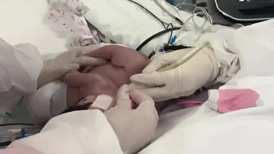 Gêmeas siamesas nascidas em Manaus passam por cirurgia de separação em Goiás; veja estado de saúde