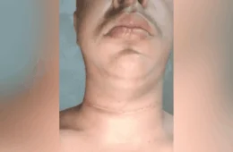 Entregador quase morre degolado por linha de pipa com cerol em avenida movimentada no AC