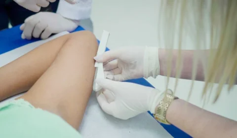 Implanon, contraceptivo moderno e de longa duração, será oferecido de forma gratuita pelo SUS