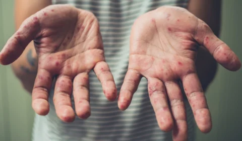 Bolívia confirma mais de 140 casos de sarampo e acende alerta na fronteira com o Acre