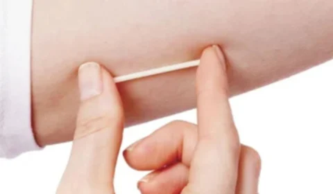 Ministério da Saúde: SUS vai oferecer implante contraceptivo para mulheres em idade fértil