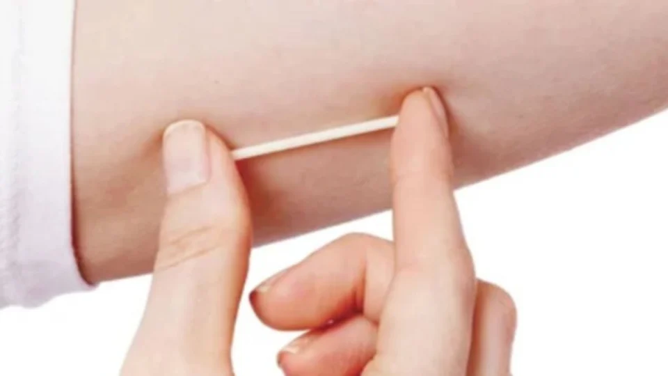 Ministério da Saúde: SUS vai oferecer implante contraceptivo para mulheres em idade fértil