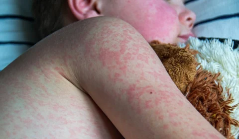 Sarampo chega a Palmas (TO) com dois casos confirmados; um deles em um bebê não vacinado