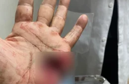 Policial militar de 76 anos atira na própria mão ao limpar arma em Caracaraí